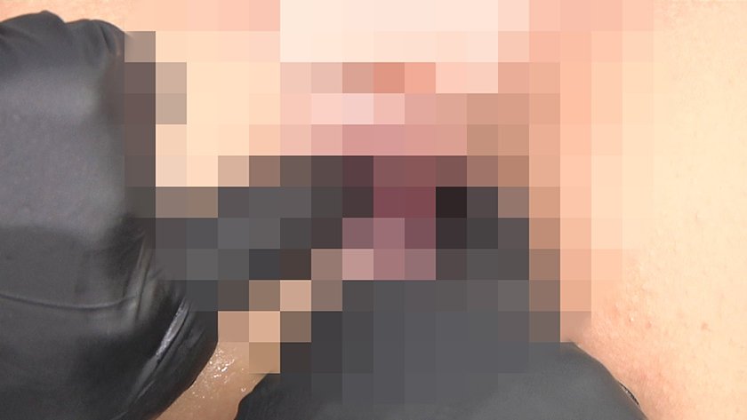 尻穴拡張クリニック 臨床手順に基づくアナル拡張記録9枚目